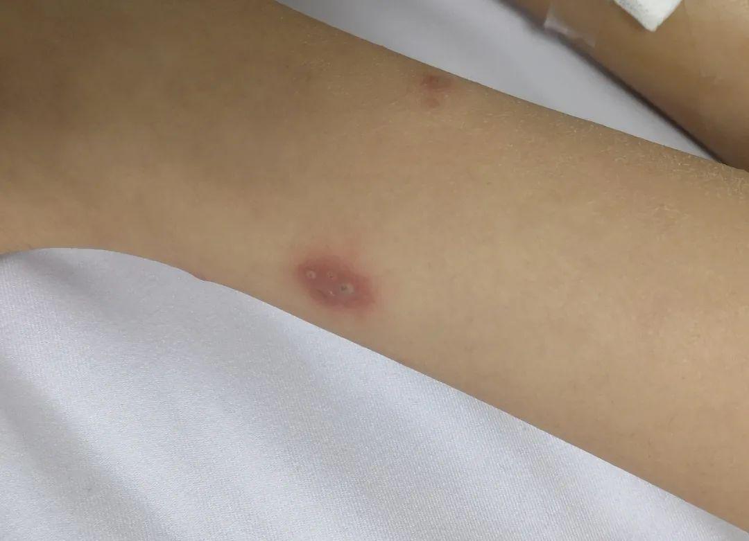 【罕见病】白塞病